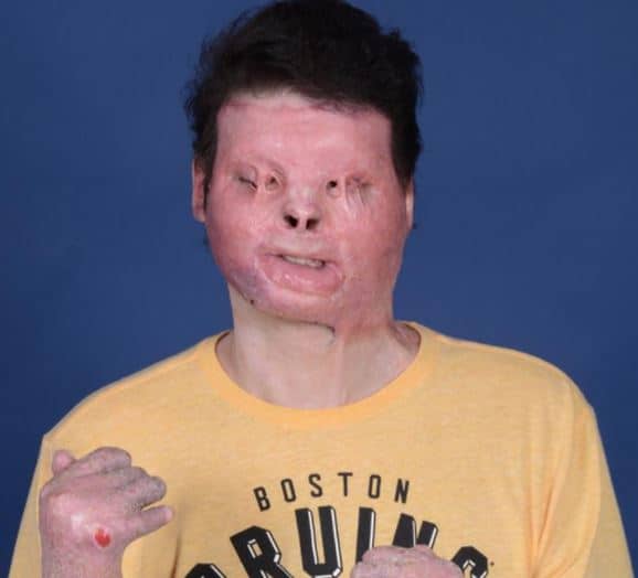 "Incredible" 22-Year-Old Man Has a Face and Double Hand Transplant After Horrific Car Crash 3 Joe Dimeo