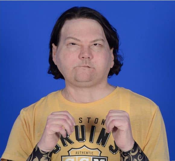"Incredible" 22-Year-Old Man Has a Face and Double Hand Transplant After Horrific Car Crash 4 NYU Langone Joe