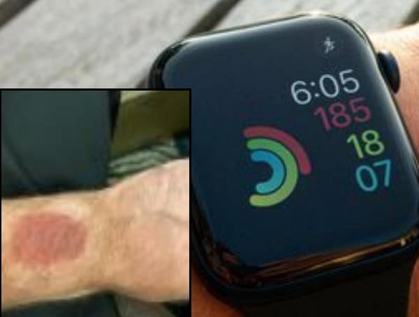 – On November 1, a lawsuit was filed in the Hillsborough County courts by an Apple watch customer who allegedly suffered a wrist burn that occurred “suddenly and without warning.” Both Apple, Inc. and Best Buy of Minnesota are co-defendants in the case which