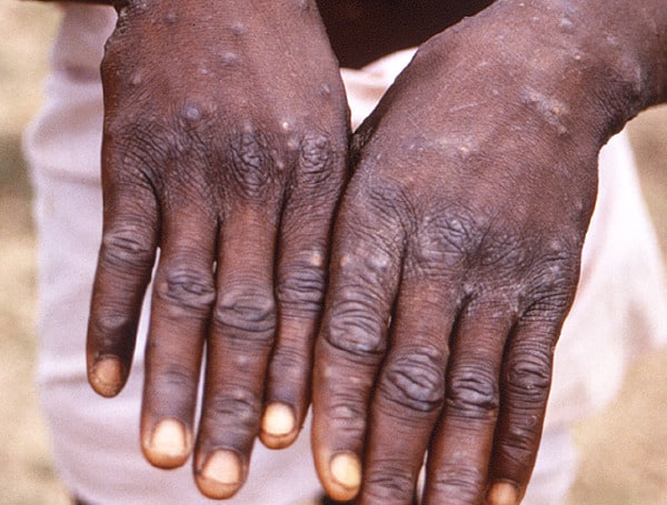 Monkeypox may be COVID-19 2.0 - at least in terms of putting wokeness over scientific accuracy.